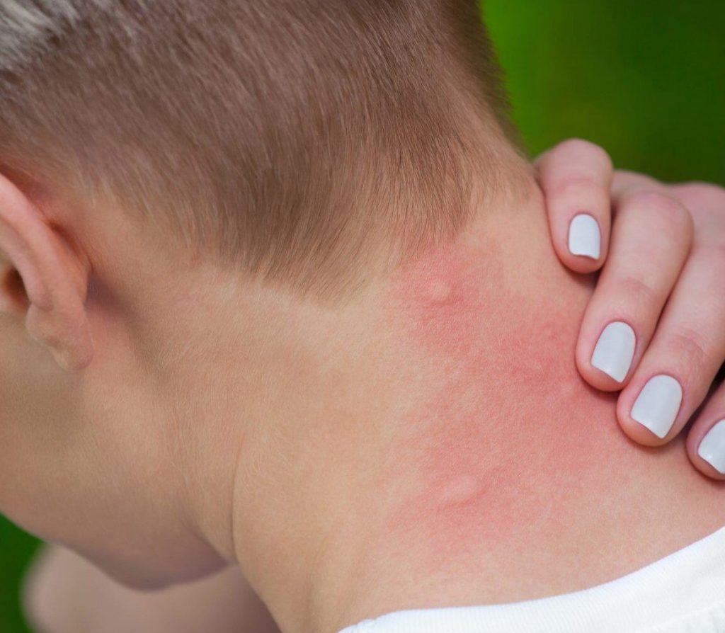Аллергия на коже - BrizerWP